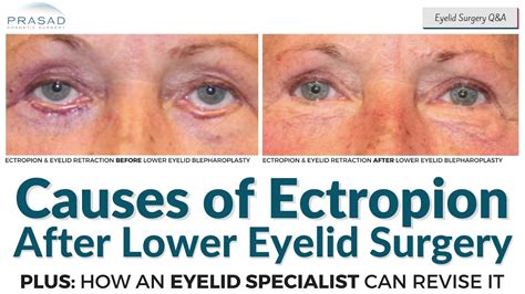 Ectropion After Lower Blepharoplasty