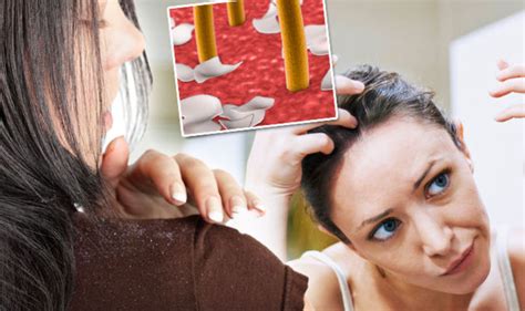 How To Get Rid Of Dandruff Fast The Food And Drink To Avoid Express