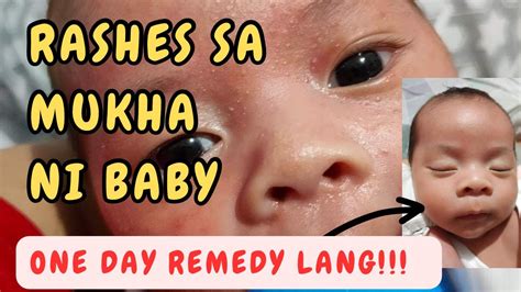 RASHES SA MUKHA Ni Baby NEONATAL ACNE REMEDY By Dr Pedia Mom YouTube