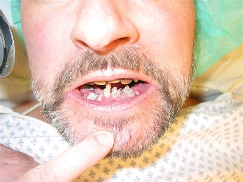 dental caries doccheck