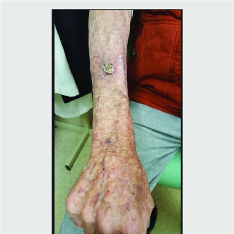 Shows A Lesion In The Right Forearm What Appears To Be A Cutaneous Cancer Download Scientific