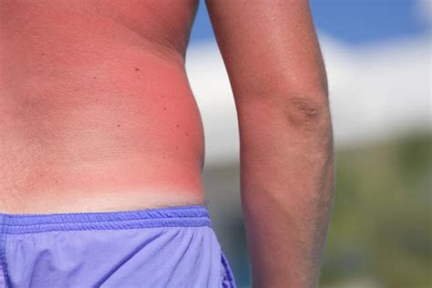 Sunburn Why Men Are More Prone Than Women