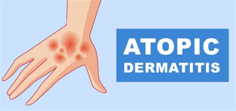 Atopic Dermatitis – Causes, Symptoms, Diagnosis, And Treatment – HealthInfoNetwork