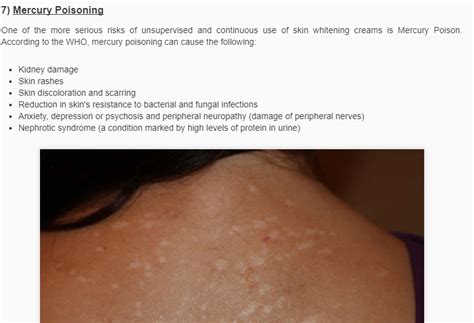 Mercury Poisoning Skin Rash