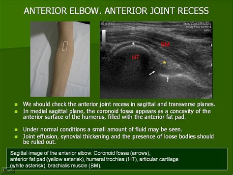 Figure From Ultrasound Of The Elbow What The Radiologist Should Know