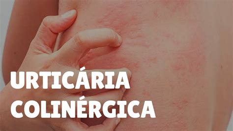 Urticária Colinérgica Causas Sintomas Tratamentos e Cura