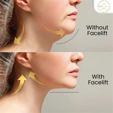 Non Surgical Double Chin Treatment In Delhi Artofit