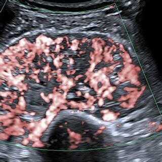 Real Time Ultrasound Images Of The Triceps Brachii Muscle Tumor A