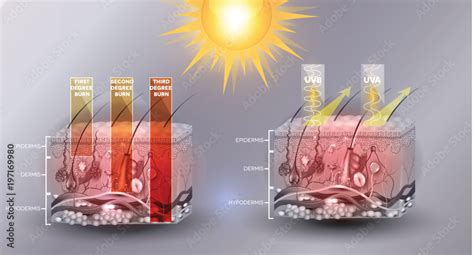 Skin Burn Classification First Second And Third Degree Skin Burns