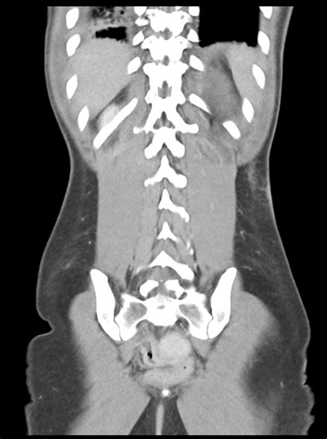 File Abdominal Multi Trauma Devascularised Kidney And Liver Spleen