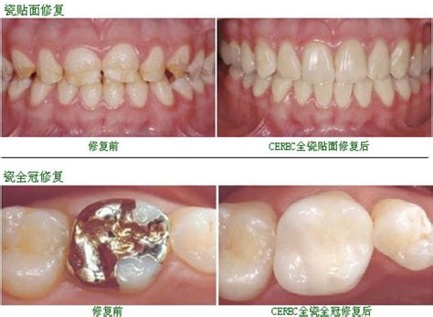 瓷睿刻cerec修复 Hkdental