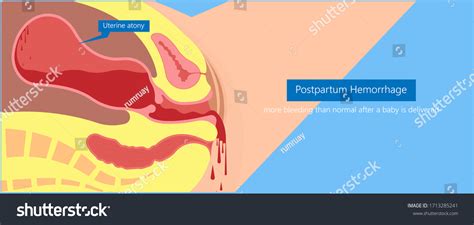 Postpartum Hemorrhage Causes Symptoms Diagnosis Off