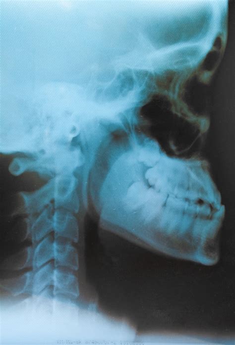 O Que é Radiografia De Cavum Dvi Radiologia