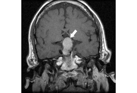 Pituitary Tumor Mri