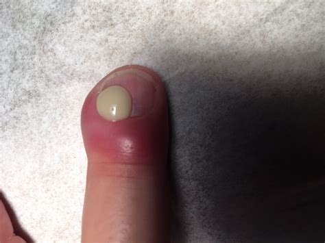 Finger Nail Infections Walk In Clinic Orlando And Windermere Urgent