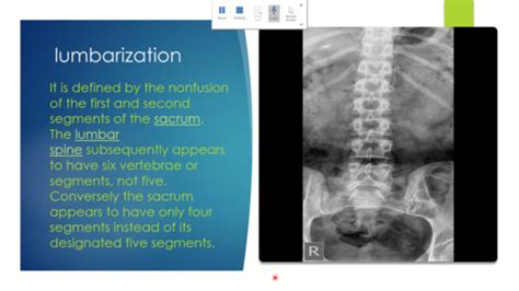 Radiographic Evaluation Of The Low Back Flashcards Quizlet