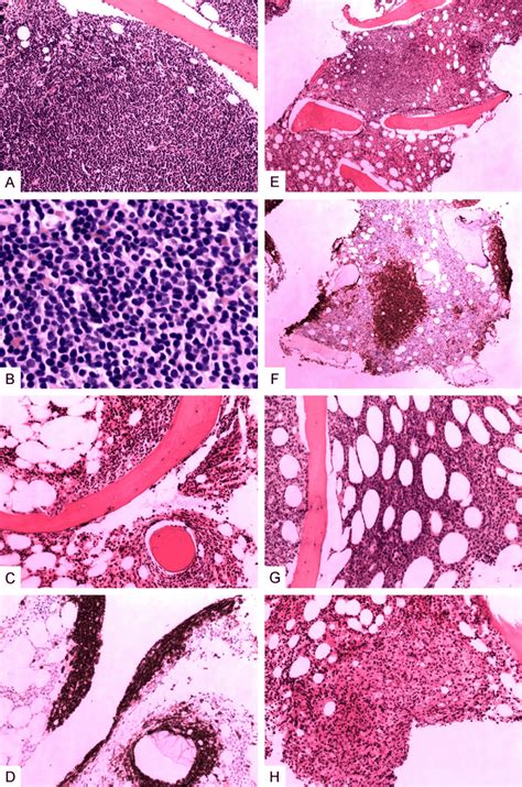 Patterns Of Lymphoma Involvement In Bone Marrow Notes Tumor Cells In