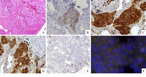 Figure 3 From Large Cell Neuroendocrine Carcinoma Harboring An