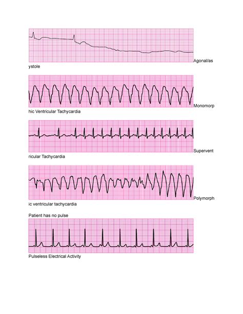 Ventricular Fibrillation Vs Ventricular Tachycardia Ecg