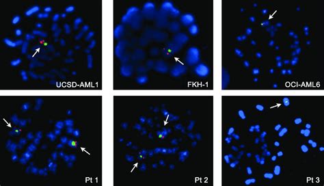 Metaphase Fish Analysis Of Aml Cell Lines With Upper Panel And Aml