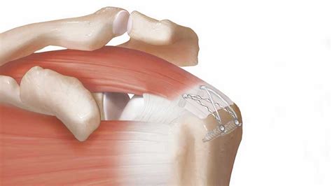 La rupture des tendons de la coiffe des rotateurs de lépaule