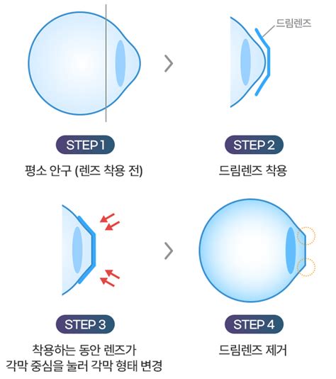 드림렌즈｜아이리움안과