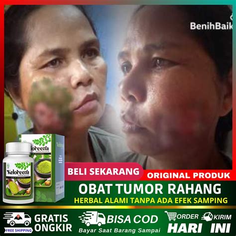 jual obat tumor rahang gusi kanker mulut suplemen pengobatan tumor