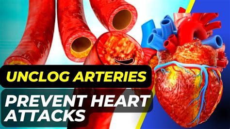 Just 1 Gram How To Unclog Arteries In The Heart Naturally Natural