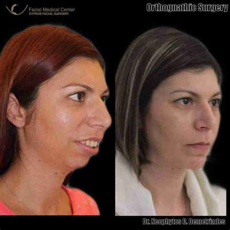 Orthognathic Surgery Before And After Cyprus Facial Surgery