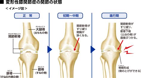 1変形性膝関節症とは？｜よくわかるほねとひざcom