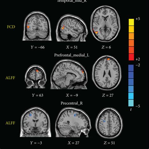 Brain Regions Showing Differences In Fcd Or Alff Values Between The