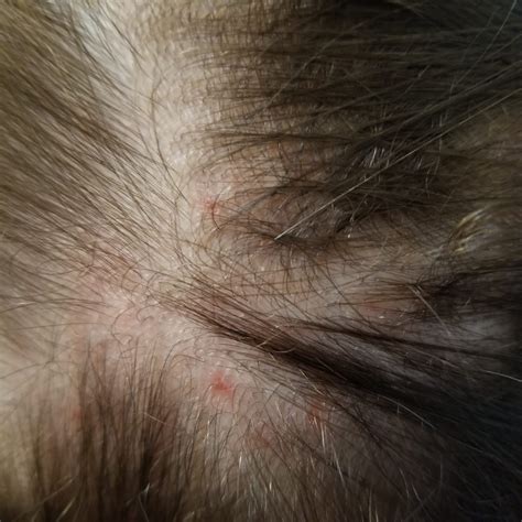 Spots On Scalp Often Itchy Ive Stopped Using Anything That Might Be Irritating To No Avail