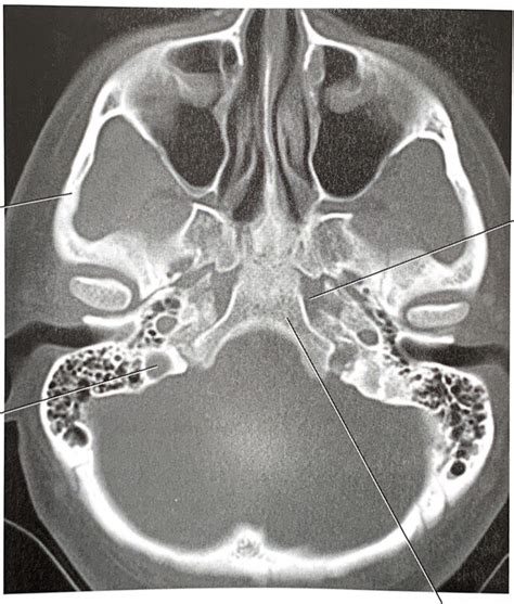 Axial Ct Of Temporal Diagram Quizlet