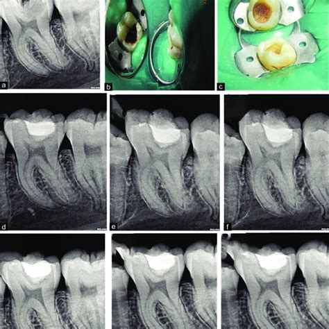 Partial Caries Removal Case Preoperative Radiograph A Preoperative