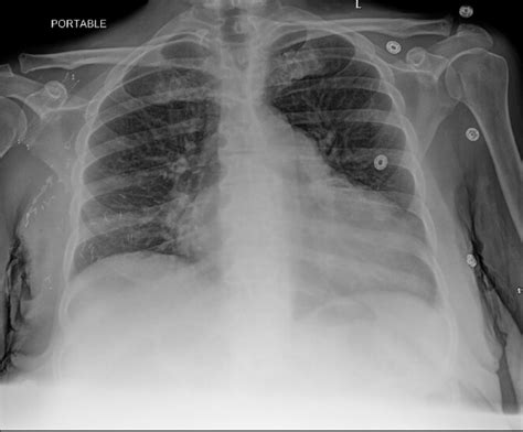 An Unusual Case Of Isolated Native Pulmonic Valve Enterococcus Faecalis Endocarditis Authorea