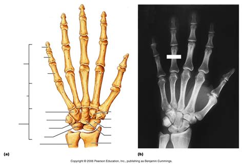 Hand Bones Palmar View Diagram Quizlet