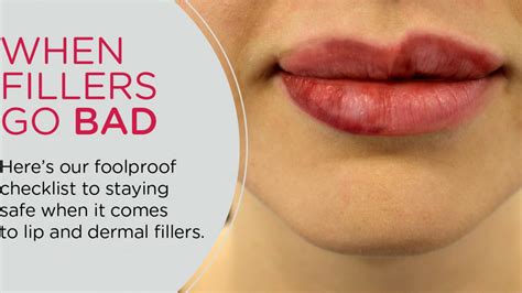 Whiteheads On Lips After Filler Lipstutorial Org