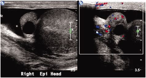 Testicular Cyst Ultrasound