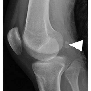 (PDF) Fracture of the Fabella: A Rare Injury in Knee Trauma