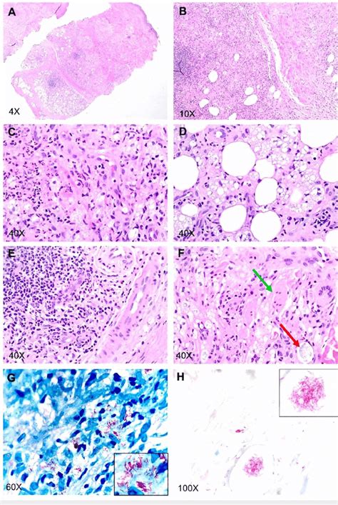 Pictures Showing Hande Fite And Afb Staining Of Skin Biopsy A F Hande Download Scientific