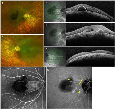 Fundus Photography Optical Coherence Tomography Oct And Fluorescein