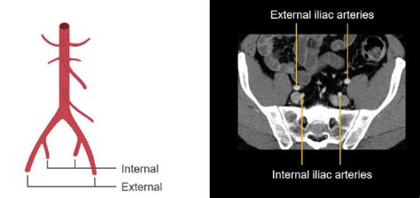 Abdominal Ct Abdominal Arteries • Litfl • Radiology Library