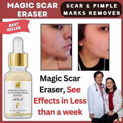 Best Seller Niceahh Magic Scar Eraser Scar Pimple Marks Remover