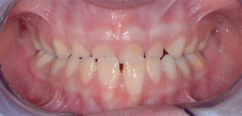 Intraoral Pre Treatment Pictures A Frontal View B Frontal View Of