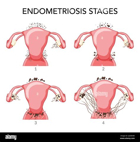 Set Of Endometriosis Stages Female Reproductive System Pain Pcos Tissue