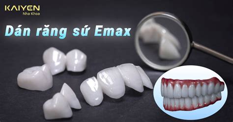 Dán răng sứ Emax có tốt không Cập nhật giá dán sứ Veneer Emax Nha