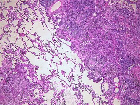 Tuberculosis Lungs Histology