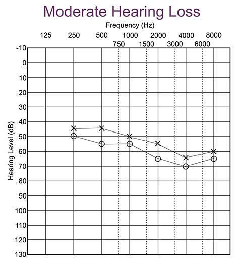 What is an Audiogram? – Understanding Hearing Test Results ...