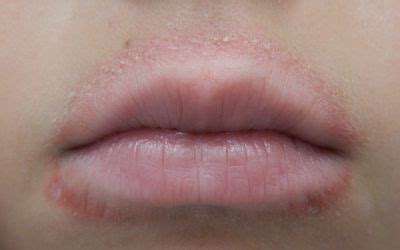 Staph Infection Chapped Lips Lipstutorial Org