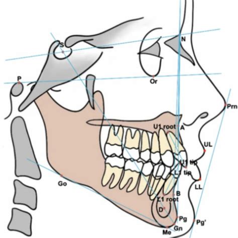 Cephalometric Landmarks And Measurements In Terms Of Bone Teeth And Download Scientific